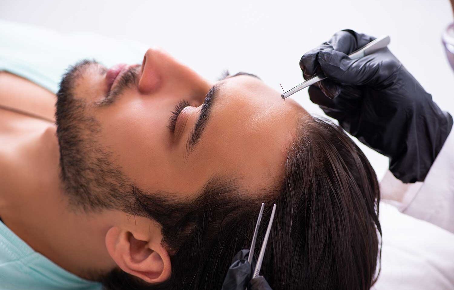 Challenges Facing Hair Replacement Clinics in 2023 UCFS